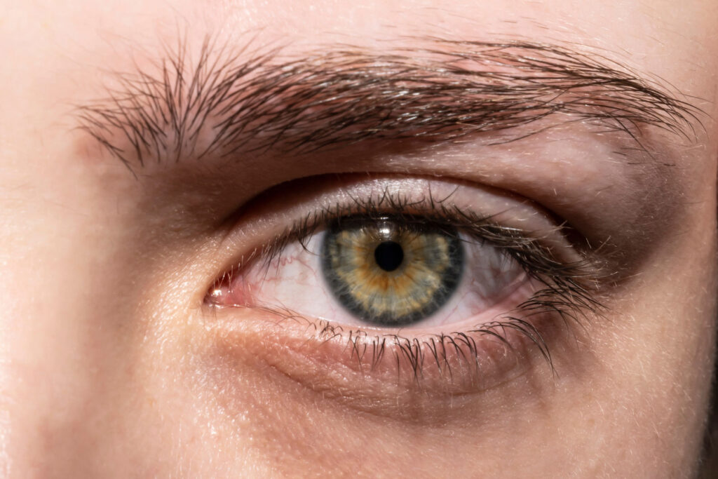 Eye of a person displaying signs of fentanyl use